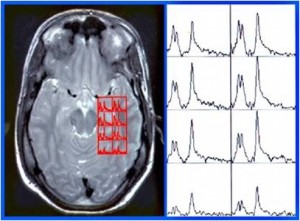 La Espectroscopia por Resonancia Magnética es una técnica no invasiva que aporta información complementaria a la imagen por resonancia magnética.