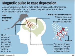 tms-depression